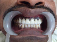 after dental treatment